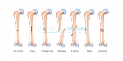 Tipos De Fracturas Óseas